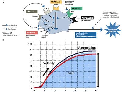 Why Me? To Be an Ultra-Responder to Antiplatelet Therapy: A Case Report